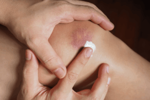 Crème pour contusion Pharmacie de Yerville